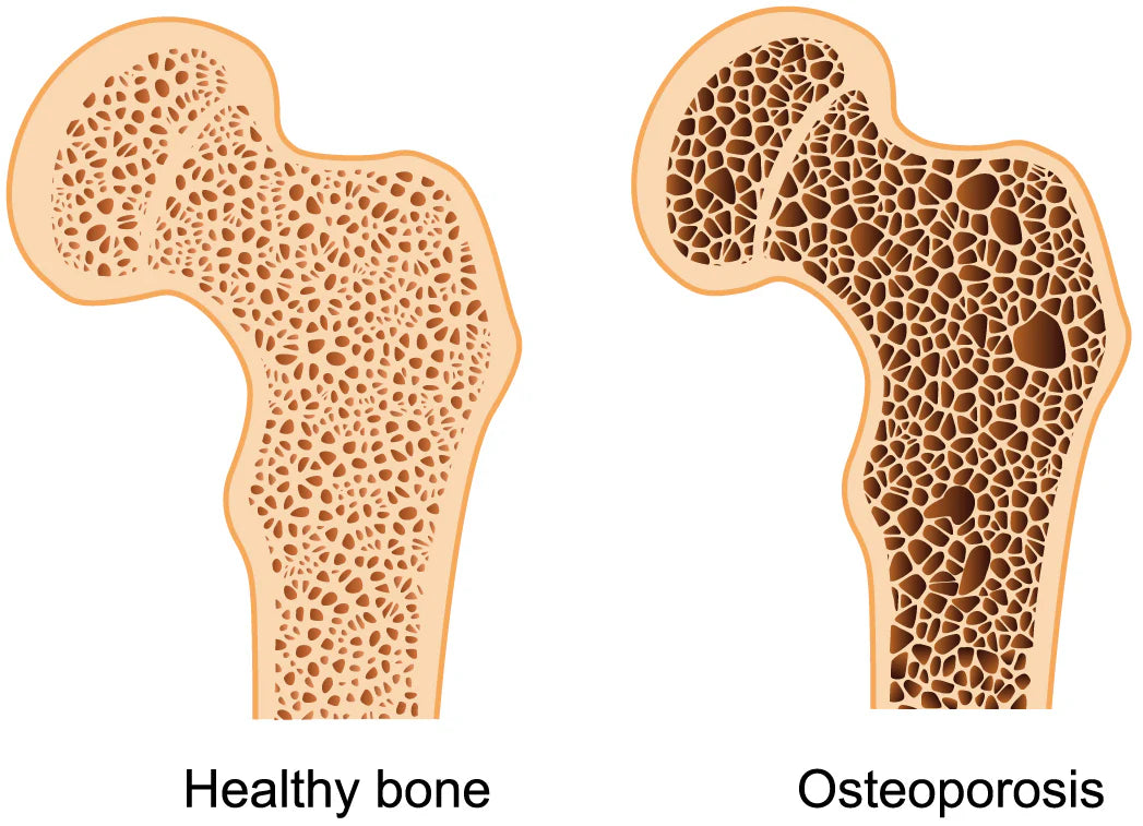 Weak Bones and Joint Pain